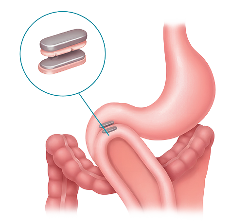 sleeve gástrico en Colombia minimamente invasivo
